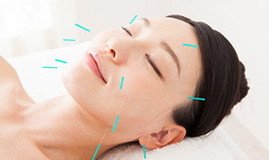 美容鍼